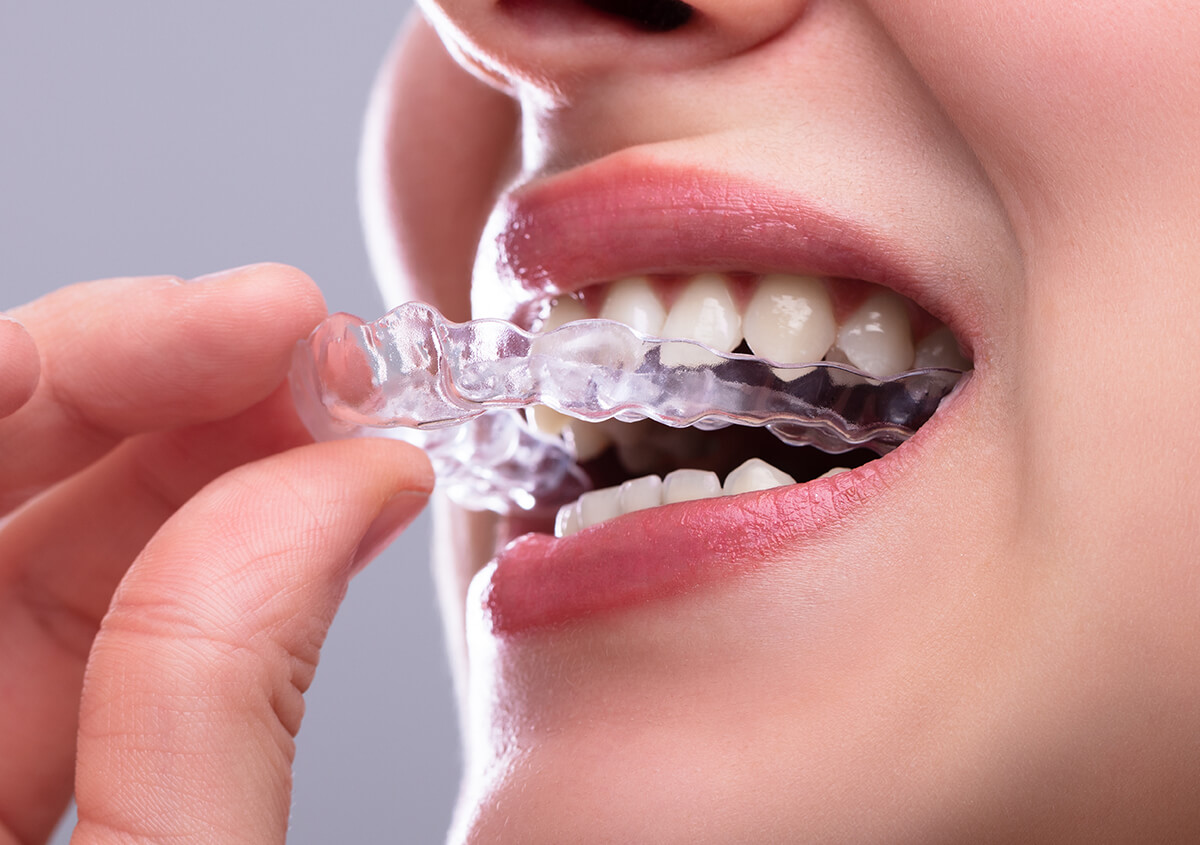 Straighten your teeth discreetly with Invisalign clear aligners