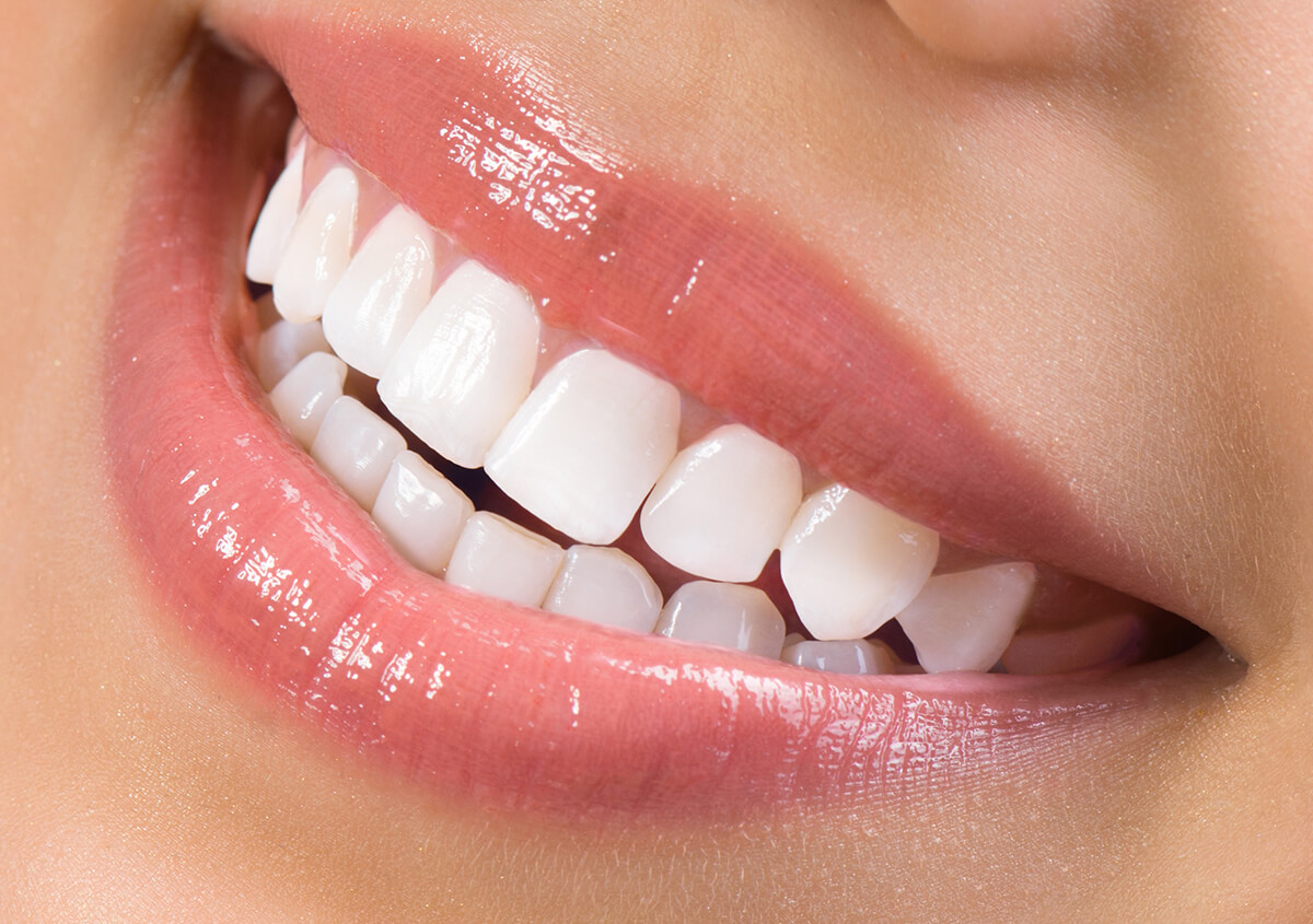 Make your cosmetic flaws a thing of the past with Dental Veneers