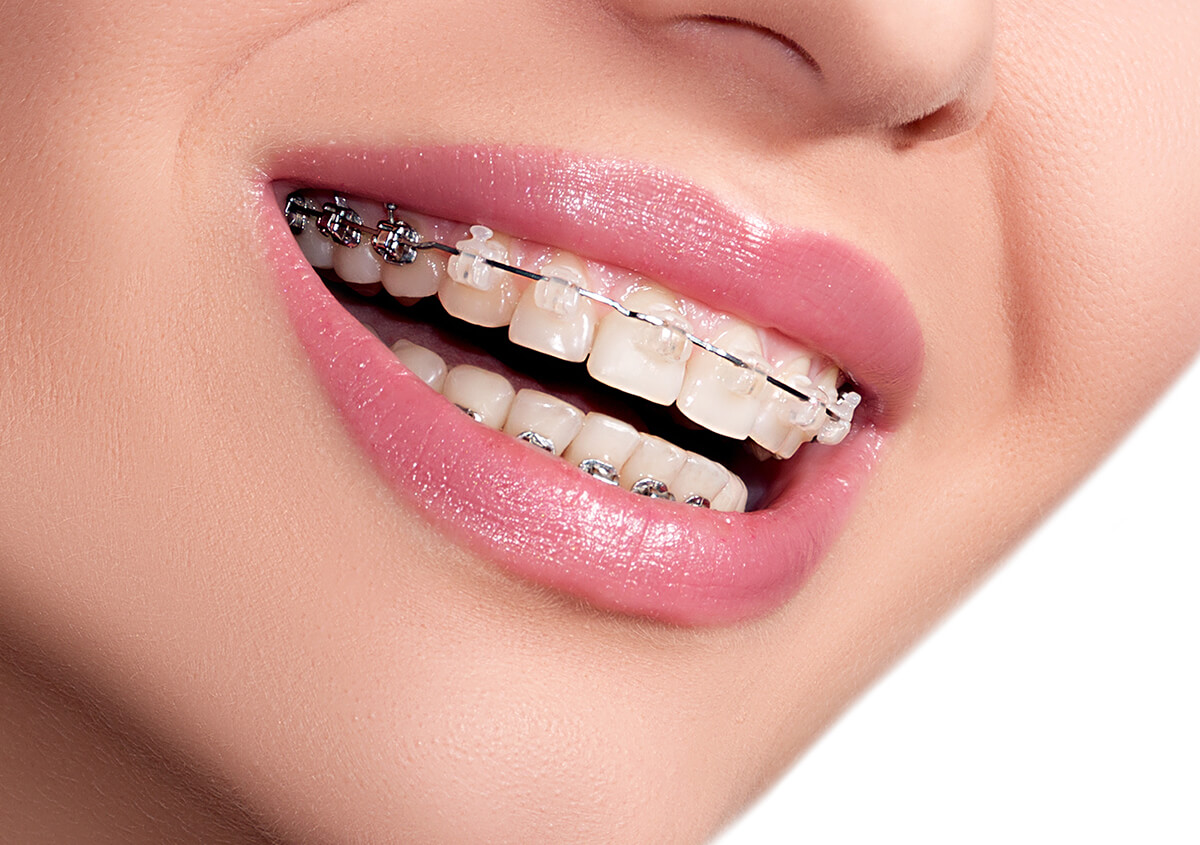 Top benefits of Orthodontic Treatment