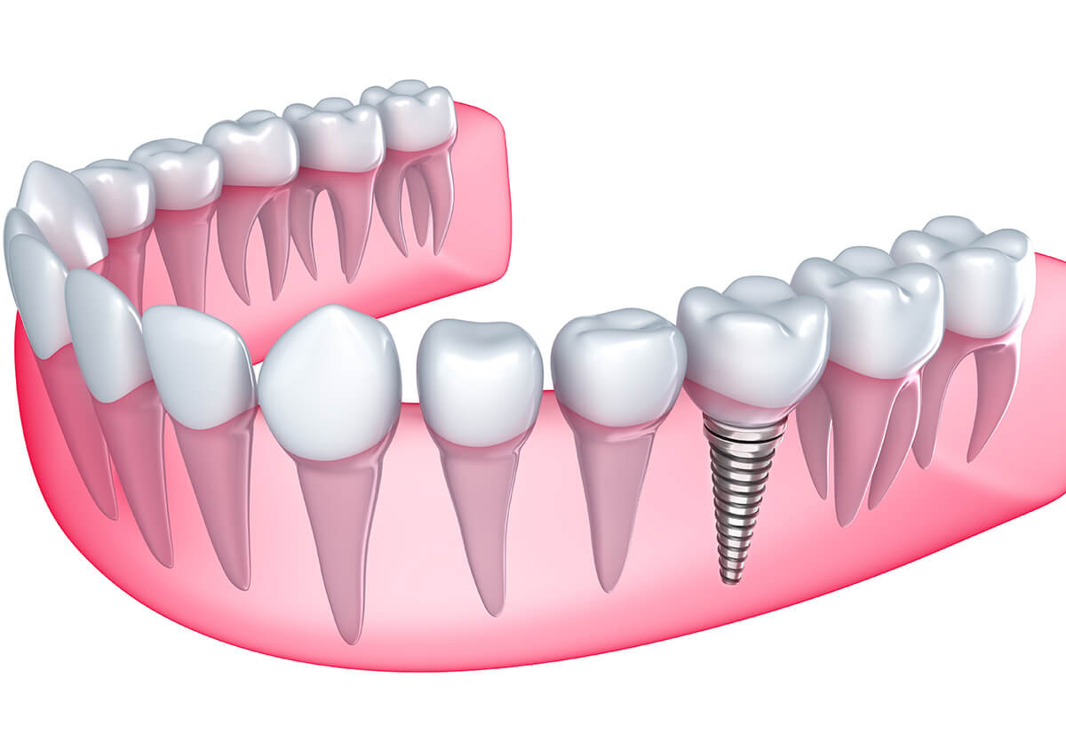 Teeth Implants in Los Banos CA Area