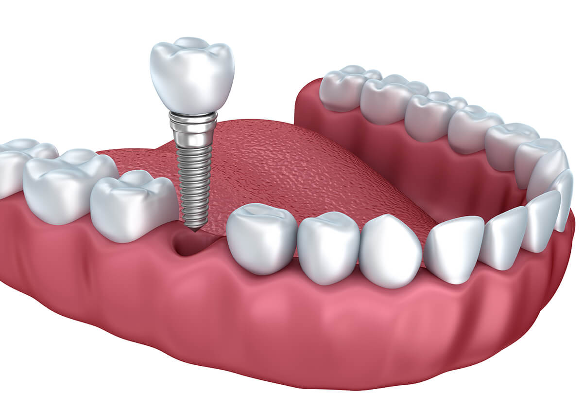 Titanium Dental Implant in Los Banos CA Area
