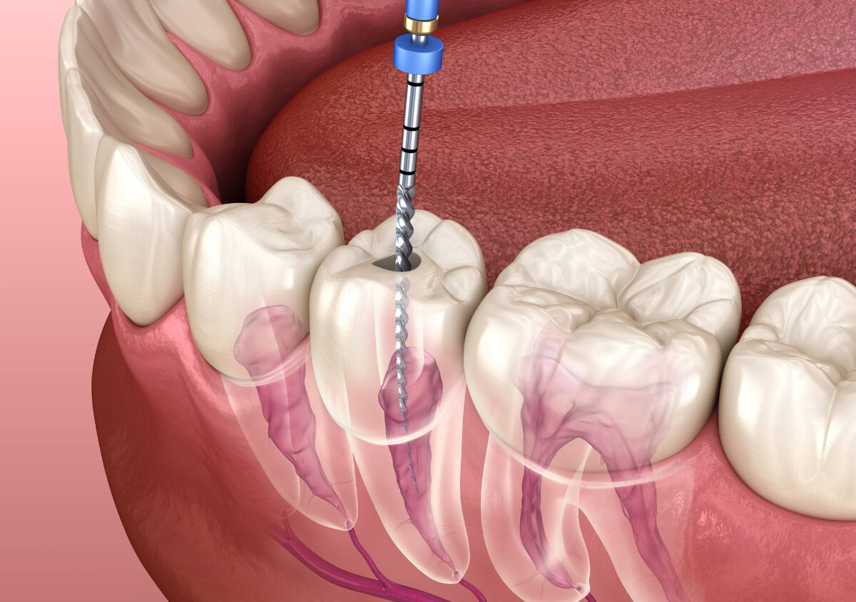 Root Canal Treatment in Los Banos area