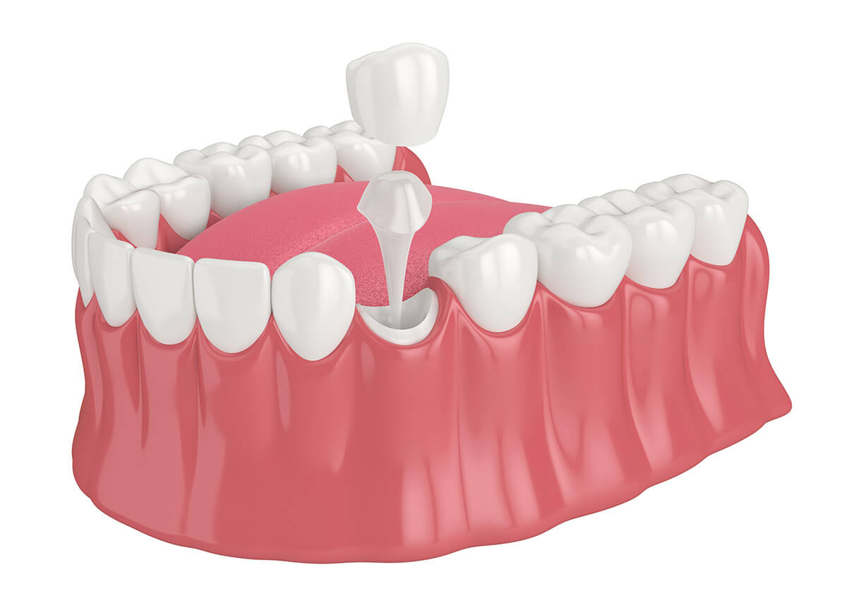 Dental Crown Replacement in Los Banos CA Area